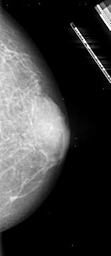 2 Base de Imagens A Digital Database for Screening Mammography (DDSM) [Heath et al.