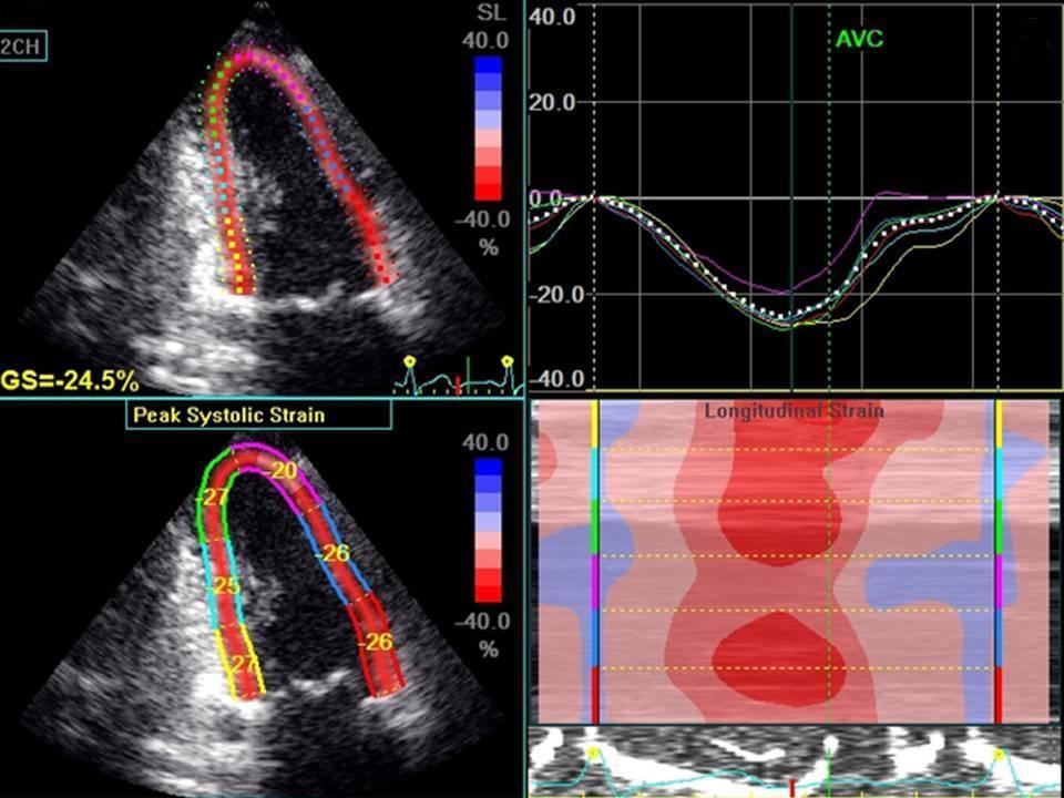 Introdução A estimativa da fração de ejeção do ventrículo esquerdo (FEVE) é um dos principais objetivos de um estudo ecocardiográfico, sendo geralmente realizada por meio da fórmula de Teichholz ou