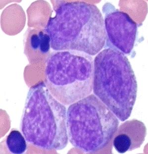 Leucemia Mielóide Crônica.