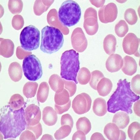 Leucemia Linfocítica Crônica. Aspectos laboratoriais Linfocitose monoclonal superior a 5000 / µl.