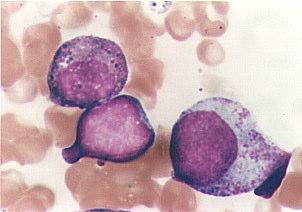 Leucemia mielóide com poucos blastos   32