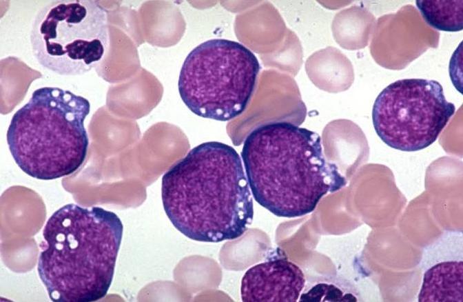 Leucemia linfoblástica aguda. L3 LLA: Classificação imunológica.