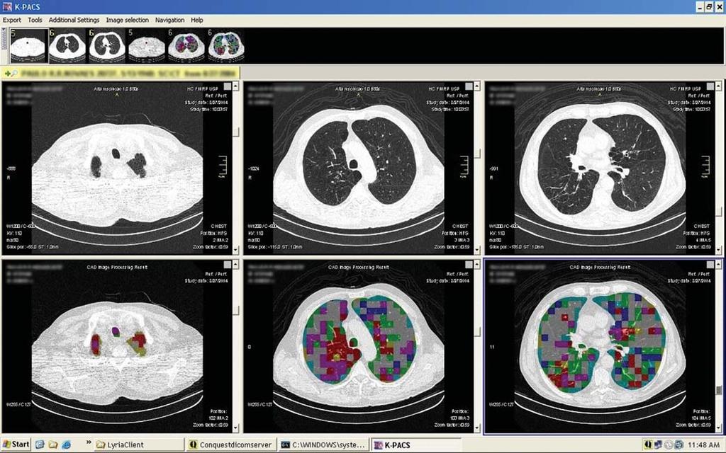 Figura 6. Exemplo de tela de visualização. Módulo de visualização do K-PACS após a integração CAD-PACS. A porção superior apresenta as séries de imagens originais do paciente.