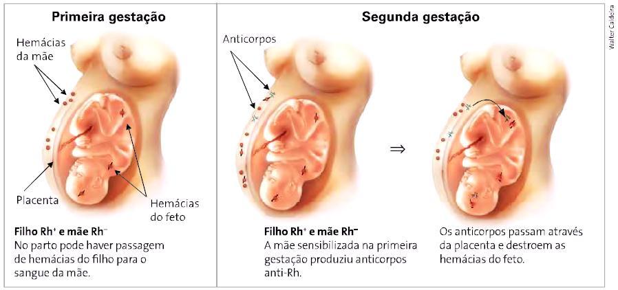 Eritroblastose fetal (doença hemolítica do recém-nascido) Doença gerada em um feto quando há incompatibilidade de fator Rh com sua mãe.