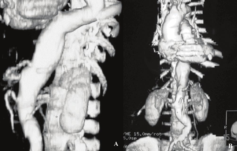 Endoprótese ramificada para artérias viscerais Simi A et al. J Vasc Bras 2007, Vol. 6, Nº 1 88 Fluency 6x60mmereforçointerno com Zilver Stent 8 x 40 mm.