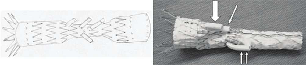 10 x 60 mm. O controle angiográfico mostrou posicionamento adequado do corpo principal da endoprótese e das ramificações (Figura 5).