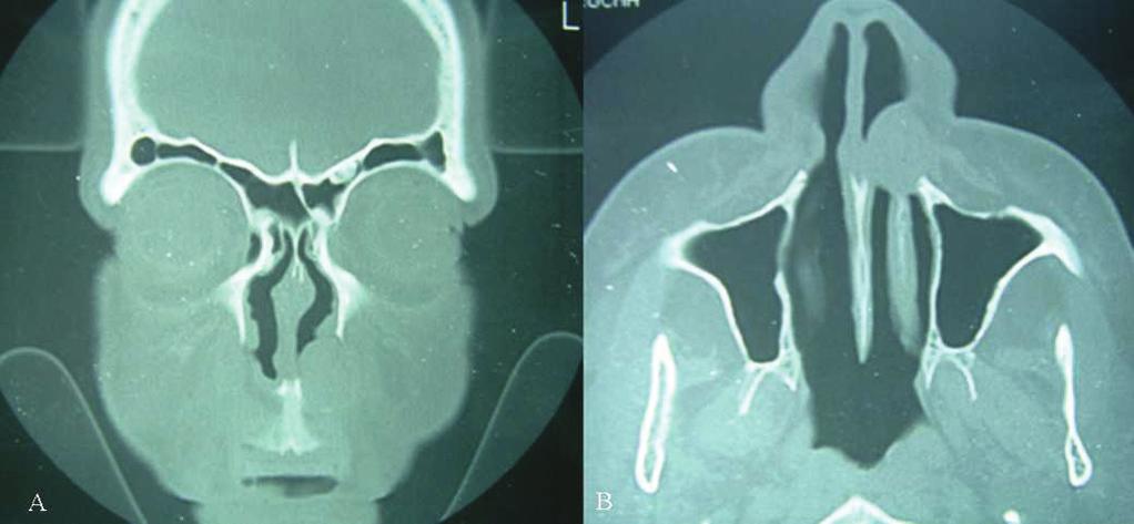 Tabela 2. Dados dos pacientes com relação aos sintomas, tempo de evolução, achados tomográficos, tamanho do cisto, tipo de cirurgia, seguimento pós-operatório e recorrência.