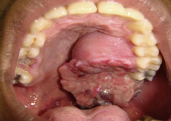 Os osteossarcomas são responsáveis por aproximadamente 20% de todos os sarcomas e surgem em diversas situações clínicas, incluindo alterações ósseas preexistentes, traumatismos prévios, osteogénese