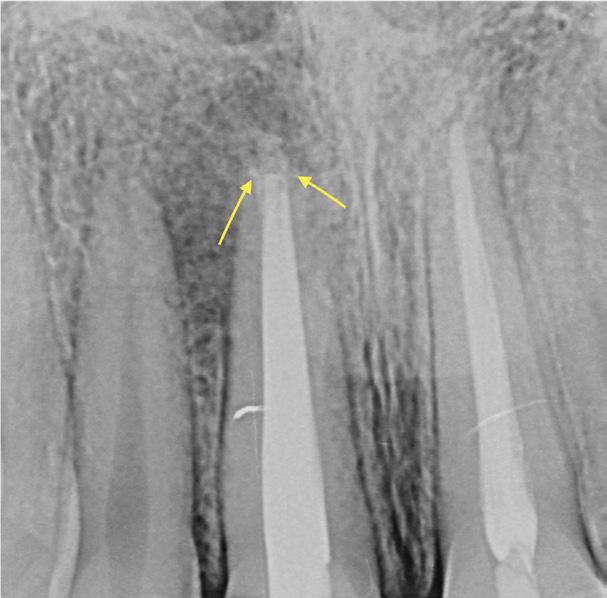 apical apontada pelas setas.