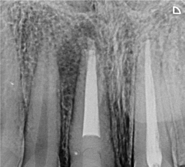 lesão perirradicular 3B.