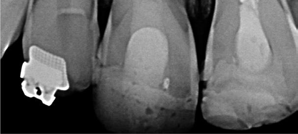 Figura 2: Radiograﬁa após a