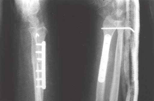 Fig. 4 Pac. C.M.M. (caso nº 5): radiografia no pós-operatório imediato de reconstrução de rádio distal com enxerto livre osteoarticular de fíbula proximal.