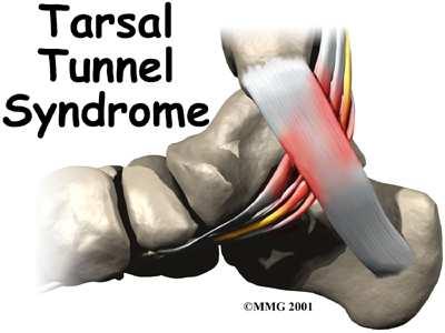 Gravidez Síndrome do Túnel do Carpo: Dor Formigamento Diminuição de força