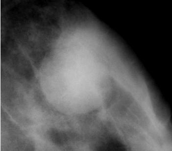 na definição de detalhes. Biópsia com agulha grossa: fibroadenoma. A. NÓDULOS 2. Margem b.