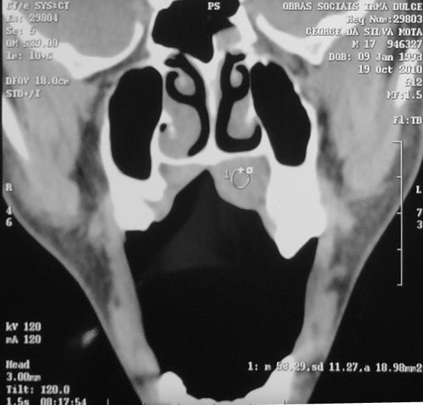 626 Fig. 2 Tomografia Computadorizada e (janela tecido mole). Fig. 3 Radiografia Panorâmica.