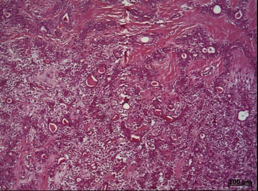 ductais com duplas de células, metaplasia escamosa e áreas de cistificação, com diagnóstico conclusivo de adenoma pleomórfico de glândulas salivares menores (UFBA 138/11) (Fig. 5).