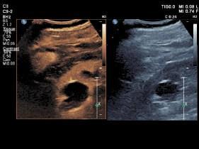 Elastografia de mama Ultrassom renal de contraste aprimorado Elastografia hepática Informações clínicas mais definitivas sobre a rigidez tecidual O Affiniti 70 é o único sistema em sua categoria que