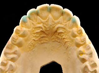 dentes posteriores.