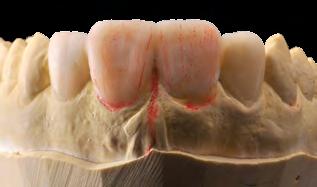 excelente para os dentes posteriores. Nos dentes anteriores, depende da presença de algum dente contralateral intacto para servir de referência (referência biogenérica ou biogenérico individual).