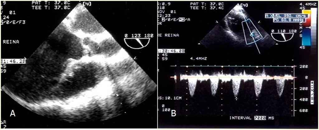 Tabela 4 Pacientes com gradientes residuais > 40 mmhg ao ETE e 40 mmhg ao ETT na via de saída ventricular direita Diagnósticos Gradientes ao ETE após saída de CEC Gradientes ao ETT T4F 57 mmhg 12