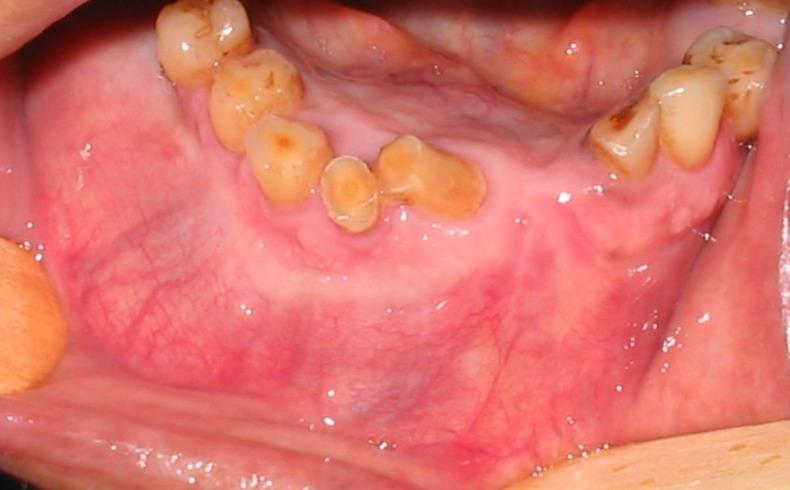 232 Fig. 2 - Aspecto intra-oral, evidenciando presença de tumefação e dentes com deslocamento percebendo-se ausência das demarcações do sulco vestibular e assoalho bucal.