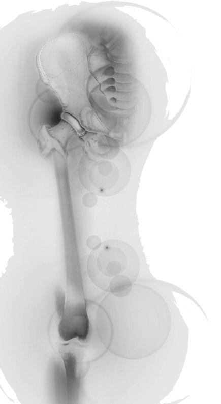 TUBERCULOSE EM DOENTES REUMÁTICOS TRATADOS COM ANTAGONISTAS DO FACTOR DE NECROSE TUMORAL ALFA : A EXPERIÊNCIA PORTUGUESA João Eurico Fonseca, Helena Canhão, Cândida Silva, Cláudia Miguel, Maria Jesus