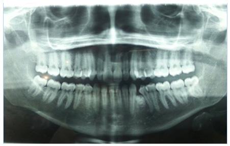 FIGURA 2 Radiografia panorâmica com imagem compatível de odontoma localizado entre