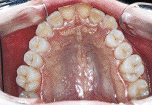 Após a distalização dos molares (Figura 20) e obtenção de uma relação molar de Classe I (Figura 21), o