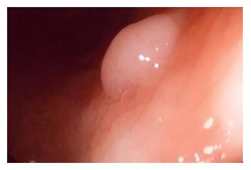 1.1 cancro colorectal e do estômago 11 Figura 6: Pólipo no interior do intestino grosso. (fonte:http://ayie-disease.blogspot.pt/2010/11/understanding-cancer-of-colon.