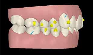 133 Planejamento O planejamento de eleição para esse tratamento foi o movimento distal dos molares superiores (após exodontia dos terceiros molares) com aparelho Invisalign assistido por