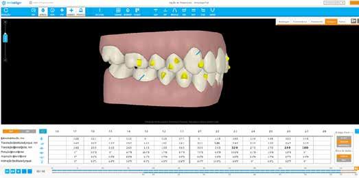 Objetivo desse procedimento cirúrgico foi acelerar a movimentação dentária dos dentes multiradiculares e diminuir a resistência óssea, favorecendo o movimento de corpo dos dentes, além de evitar uso