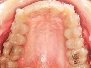 superiores e inferiores a cada 5 dias nos primeiros três meses após a realização das corticotomias.