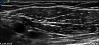 Figura 4. Sonoanatomia Pec I. A agulha será vista aproximando-se a partir do limite cefálico. A anestesia local será injetada no espaço entre o peitoral maior e peitoral menor.