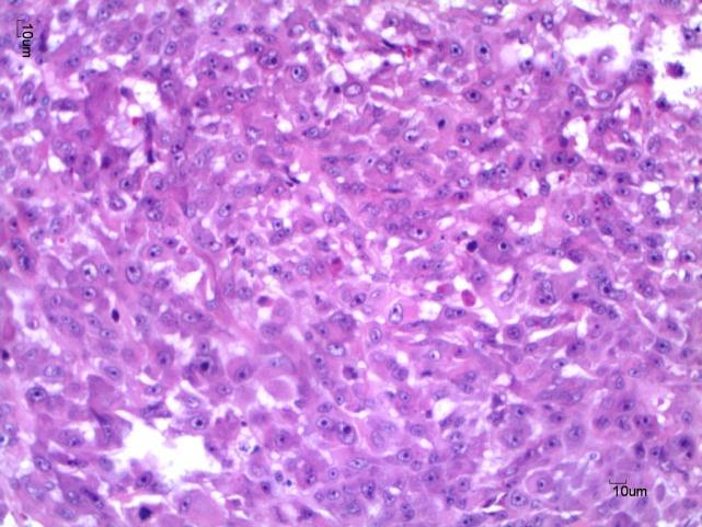 Tipos especiais de carcinoma.