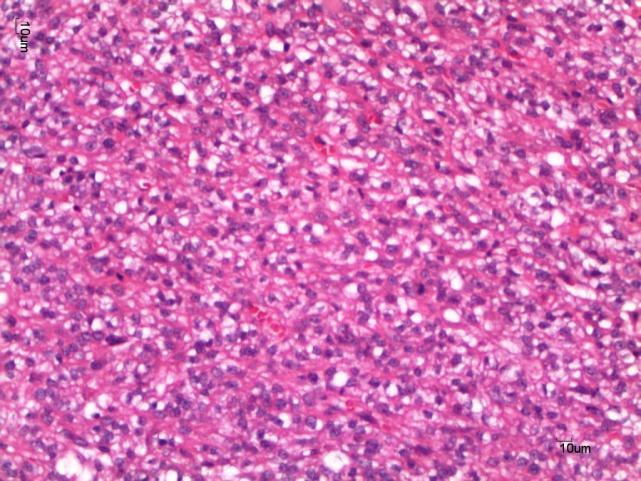 Obj. 20x. D) Carcinossarcoma.