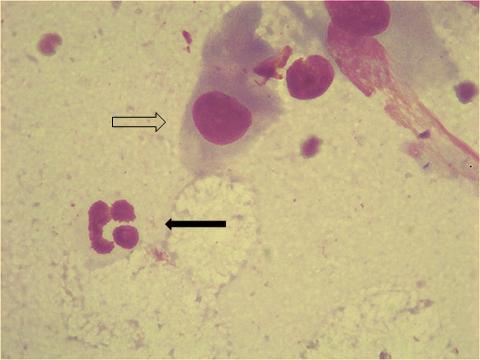 106 Esfregaço de células endometriais; observa-se polimorfonuclear (seta cheia);