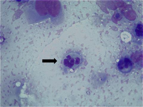 Figura 5 - Aspecto de células em endometriais em esfregaço citológico Esfregaço de