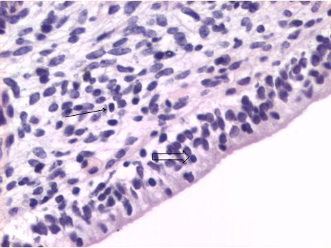 110 Endométrio bovino; no epitélio, de padrão colunar, há migração intra-epitelial de linfócitos (seta vazia); presença de infiltrado de células