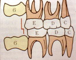 1- Plano Terminal Reto Degrau Mesial (DM): A superfície distal do segundo molar decíduo inferior