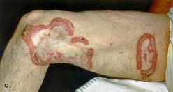 Ringworm skin infection: Tinea corporis