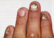 Candida albicans infection of the nails.