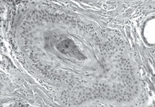 Intoxicação por Ramaria flavo-brunnescens em bovinos 91 A B C Fig.9. Histopatologia da pele da extremidade da cauda do Bovino 9, intoxicado por Ramaria flavo-brunnescens.