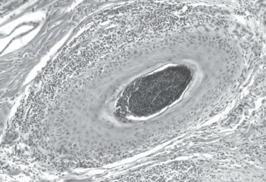 (B) Folículo piloso da derme superficial em fase telogênica com contorno irregular e espessamento da bainha radicular fibrosa. HE, obj. 40.