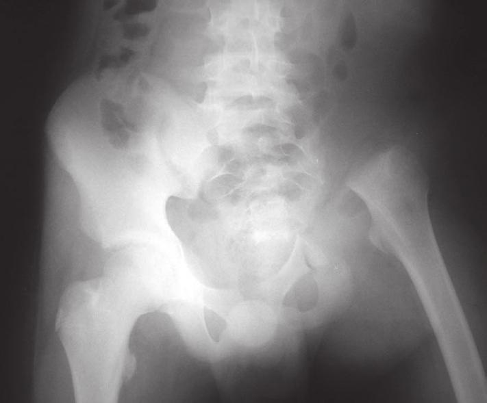 Figura 1. Radiografia controle pós-operatoria de bacia mostrando a ressecção de toda a hemibacia esquerda e a adaptação do membro inferior na deambulação com o sacro.