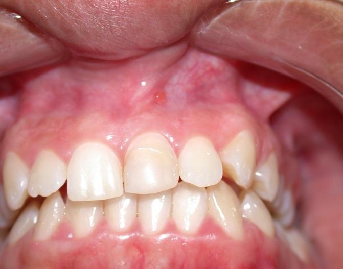 A B C D Figura 1. A. Presença de parúlide na mucosa alveolar vestibular na altura dos dentes 21 e 22. B. Cisto