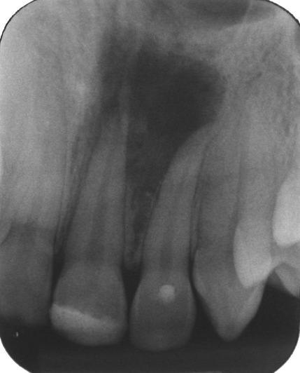 (mesmo caso que A). C. Cisto perirradicular inflamatório de grandes dimensões associado aos restos radiculares do dente 46.