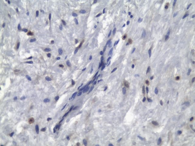 Expressão de TGF beta 1 em fibroblastos e em células