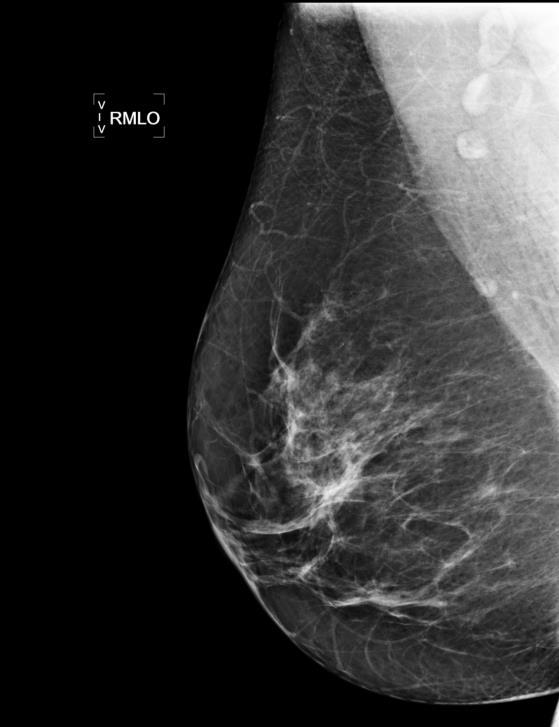 (mamografia).