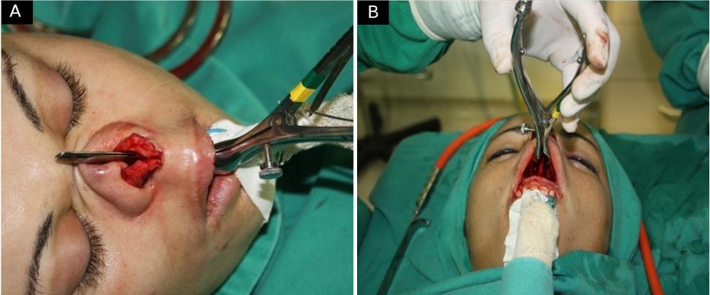 Os enxertos estruturais foram retirados do septo nasal. Figura 4.