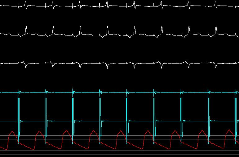 I II V2 CS p Uniform Pulsitility CS d Femoral Art.